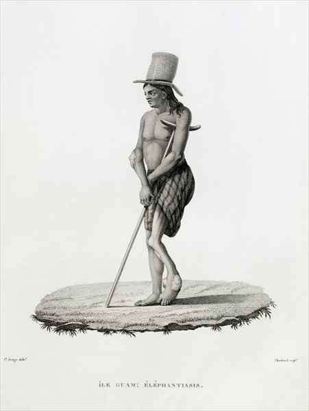 Guam: A Man with Elephantiasis, from 'Voyage Autour du Monde sur les Corvettes de L'Uranie 1817-20' by Romanticism