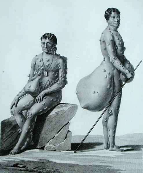 Northern Mariana Islands: Two Men Suffering from Tuberculosis, from 'Voyage Autour du Monde sur les Corvettes de L'Uranie 1817-20' by Romanticism