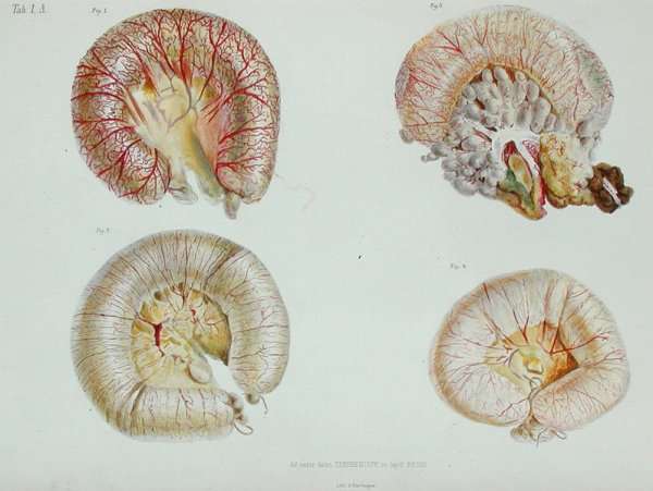The external surface of the intestines infected with cholera, from 'Anatomie Pathologique du Cholera Morbus', by Nikolai Ivanovich Pirogov 1810-81 published in St. Petersburg, 1849 by Romanticism
